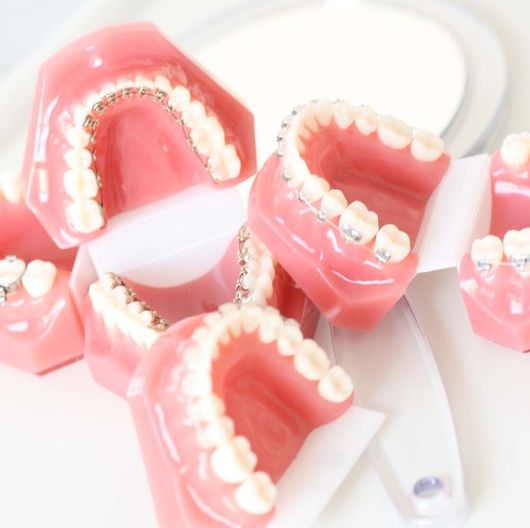 Zahnfehlstellung (Überbiss) an einem Gebissmodell